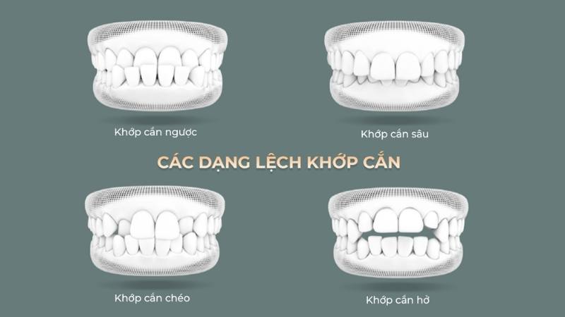 Mewing không đúng cách có thể gây lệch khớp cắn 