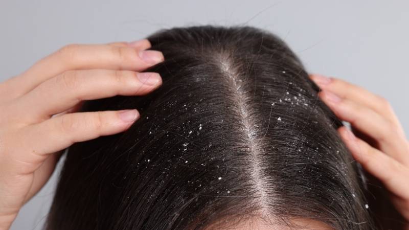 Mặt nạ đất sét có thể mang lại lợi ích trong việc giảm gàu Mặt nạ đất sét có thể mang lại lợi ích trong việc giảm gàu