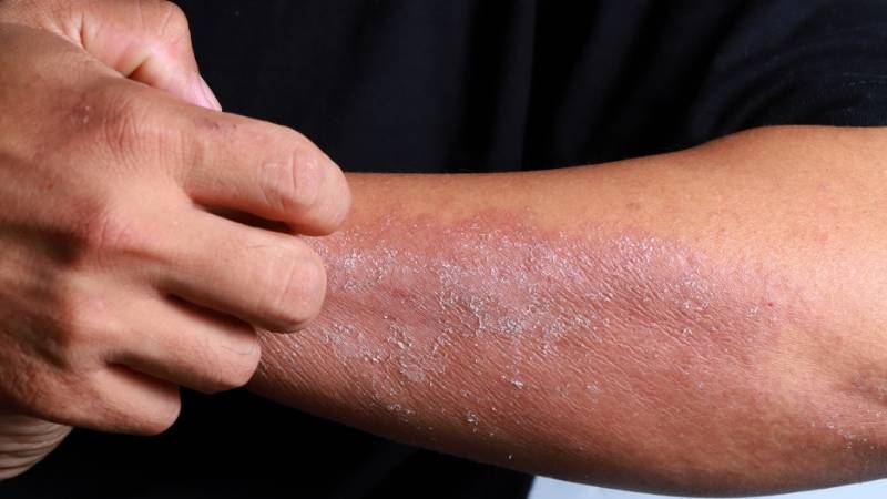 Lanolin có thể gây ra một số tác dụng phụ như nóng rát, châm chích, đỏ da