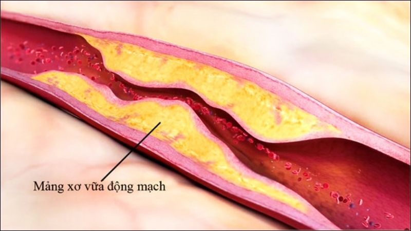 Canxi có thể lắng đọng bất thường trong các mảng xơ vữa khiến mạch máu dễ tắc nghẽn