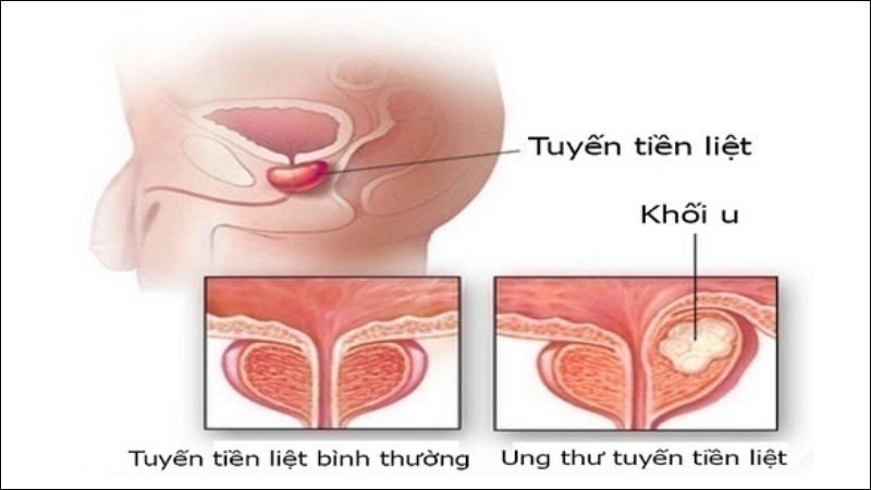 Uống canxi liều cao có thể làm tăng nguy cơ ung thư tuyến tiền liệt