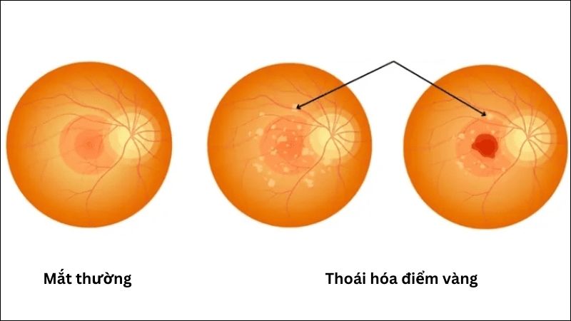 Uống canxi liều cao làm tăng nguy cơ thoái hóa điểm vàng do tuổi tác