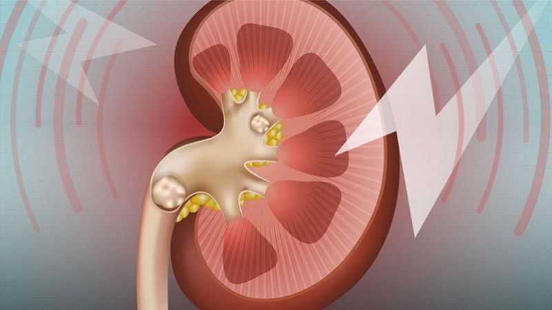 Người có tiền sử sỏi thận không nên ăn quá nhiều quả sơ ri
