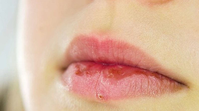 Viêm hoặc khô môi là tác dụng phụ phổ biến nhất ở bệnh nhân dùng isotretinoin
