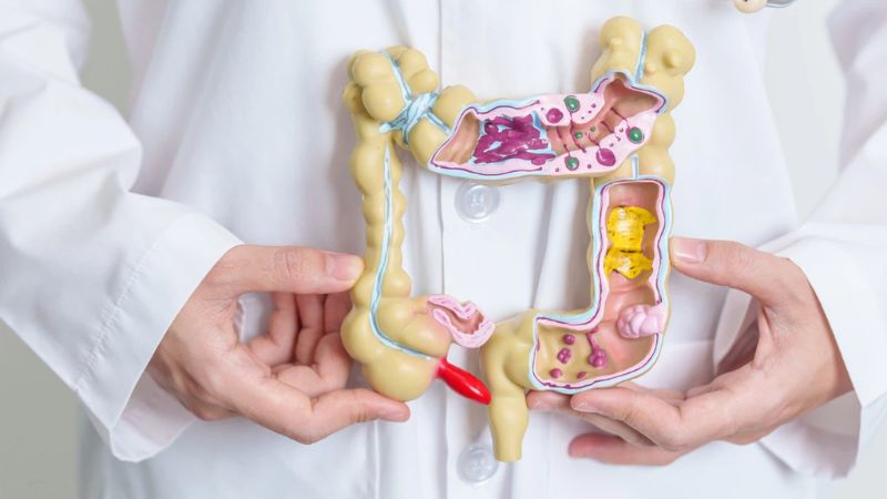 Bệnh viêm ruột (IBD) có thể xảy ra khi sử dụng isotretinoin