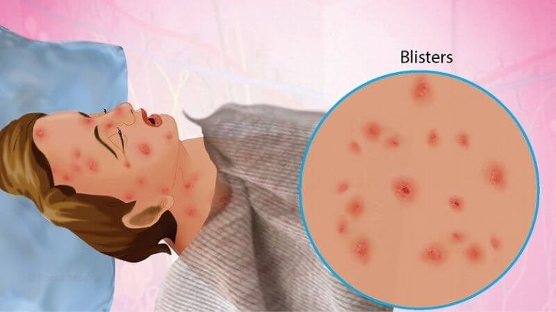 Hội chứng Stevens–Johnson là một trong phản ứng phụ khác của thuốc isotretinoin 