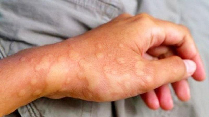 Ngứa, phát ban trên da là dấu hiệu dị ứng nặng khi sử dụng isotretinoin