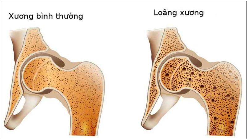 Isotretinoin khiến xương ngừng phát triển, gây loãng hoặc gãy xương