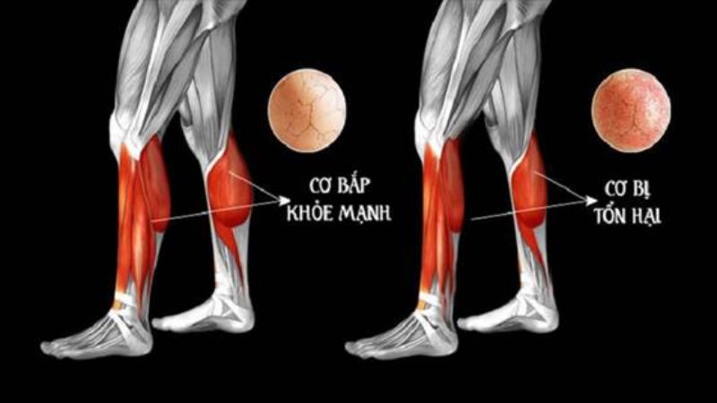 Isotretinoin có thể gây ra tình trạng tiêu cơ vân (rhabdomyolysis)
