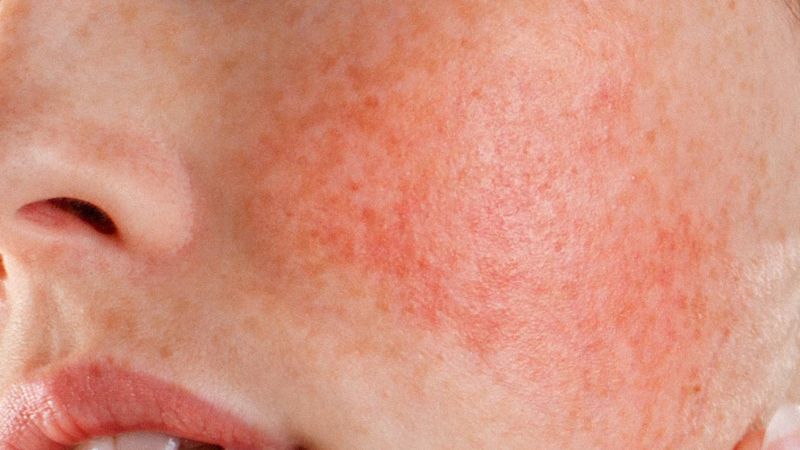 Người đang bị viêm da không nên xông hơi mặt