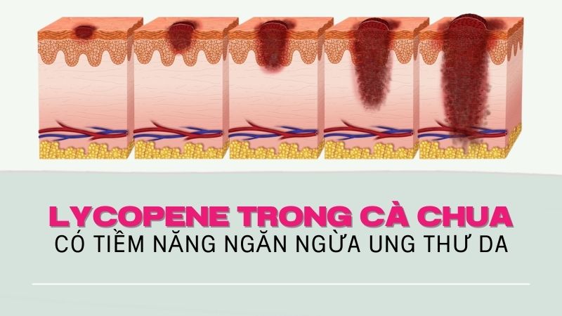 Lycopene chứa trong cà chua có tiềm năng ngăn ngừa ung thư da
