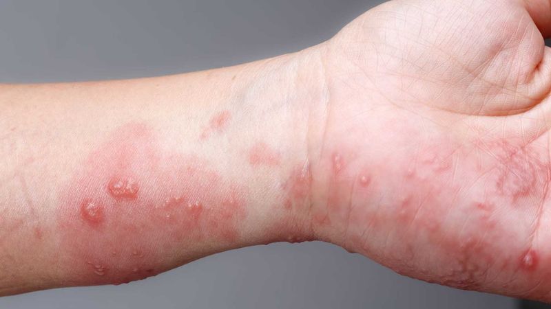Bài thuốc từ cây máu chó giúp chữa lở loét, ghẻ hiệu quả
