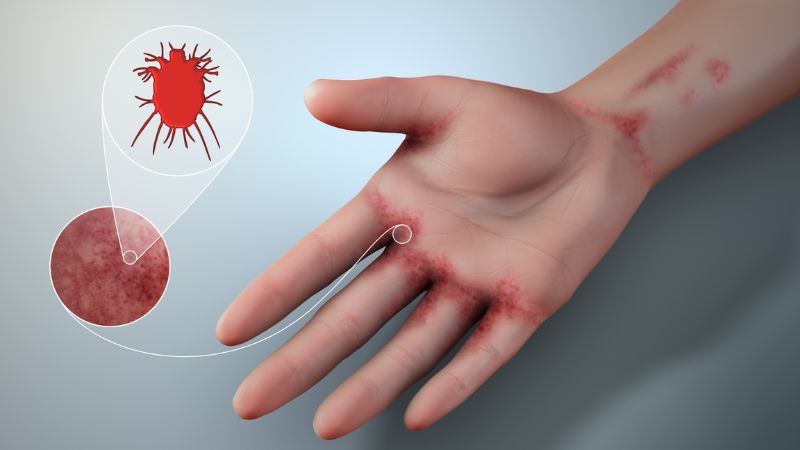 Hạt máu chó từ lâu đã được dân gian sử dụng để trị ghẻ rất hiệu quả