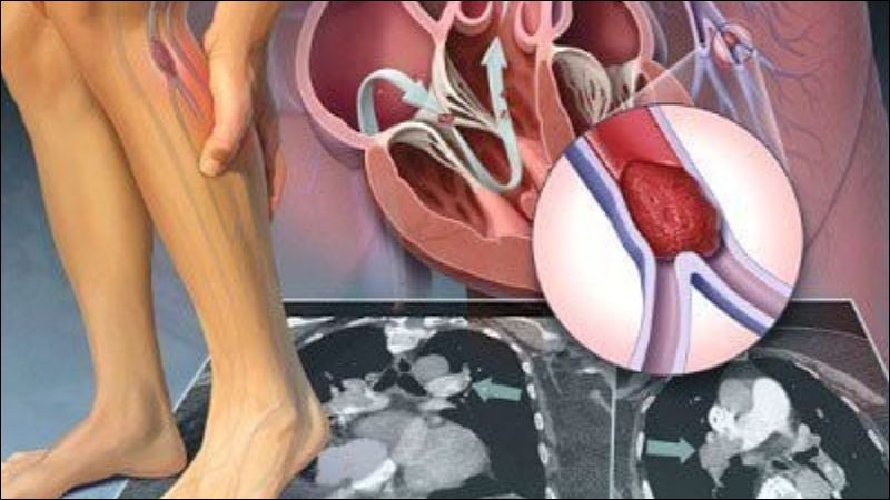 Viêm tắc động mạch chi gây nhiều đau đớn và có thể dẫn đến hoại tử chi