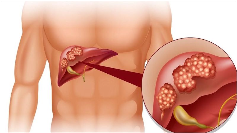 Đan sâm có lợi cho người bị gan nhiễm mỡ