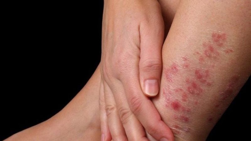 Người dị ứng hoa sen có thể gây ngứa da