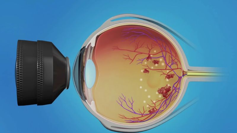 Chiết xuất methanol từ nhị hoa sen giúp ngăn ngừa biến chứng mắt của bệnh tiểu đường