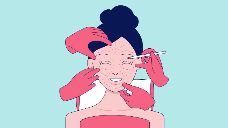 Phẫu thuật chỉnh hình mũi giúp thay đổi hình dáng mũi theo mong muốn
