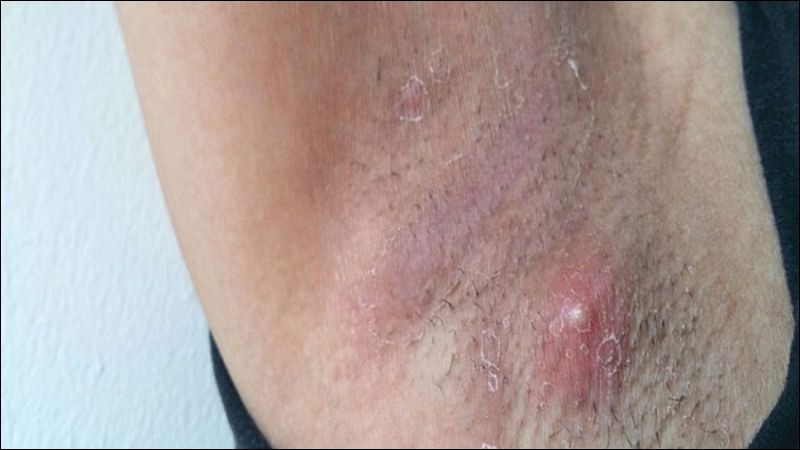 Giã nát lá non của cây ngái đắp lên nhọt ở nách để giúp giảm viêm