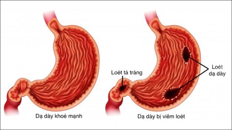 Rễ cây ngái có tác dụng hỗ trợ giảm loét dạ dày