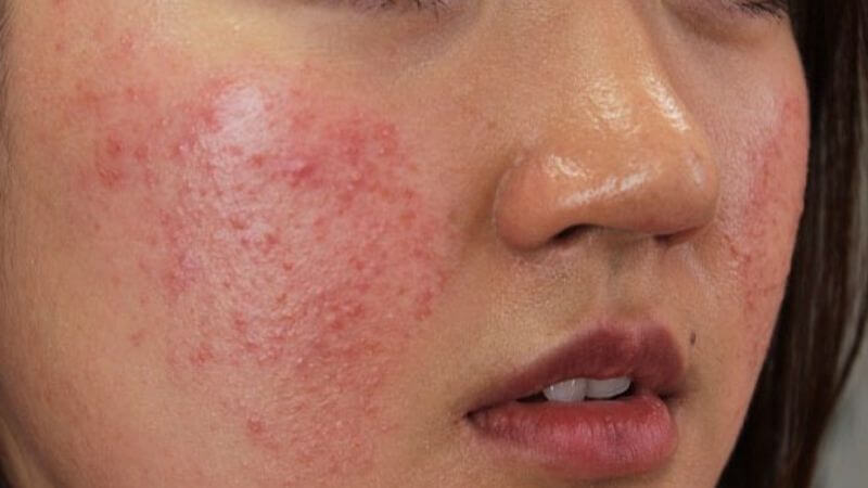 MSM trong lưu huỳnh có khả năng giảm viêm do phản ứng miễn dịch bất thường, đặc biệt ở những người bị dị ứng thực phẩm hoặc các tác nhân môi trường