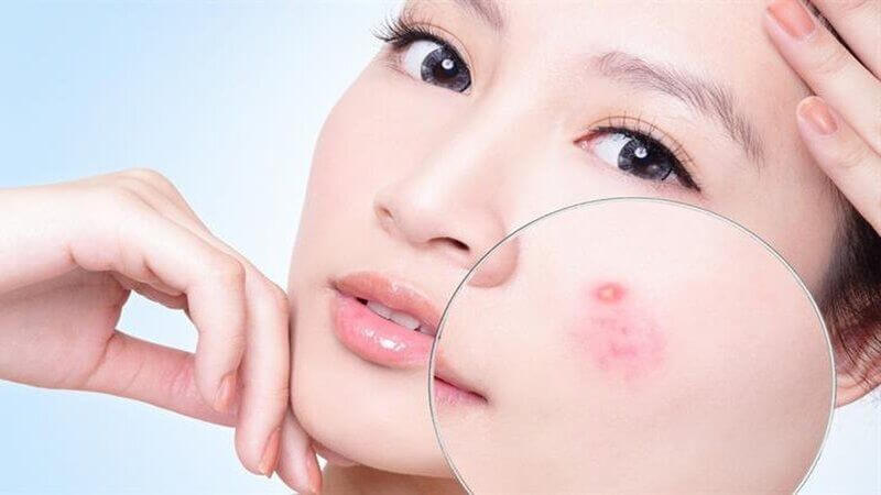 Lưu huỳnh là thành phần có trong nhiều sản phẩm trị mụn không kê đơn được FDA chấp thuận