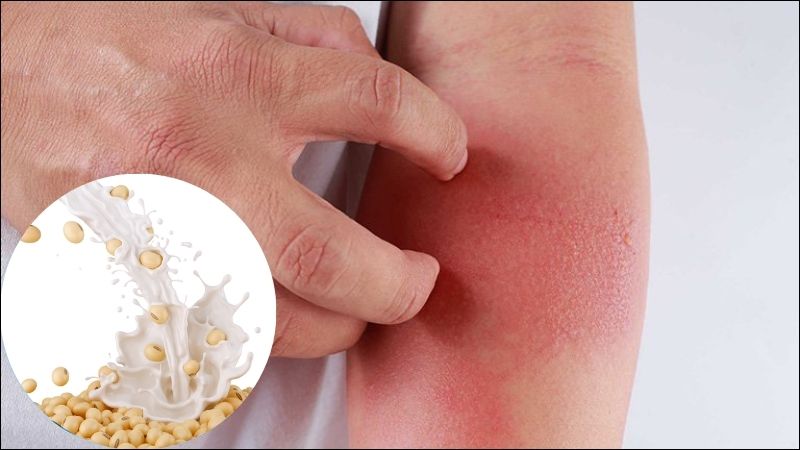 Dị ứng sữa đậu nành có thể dẫn đến phát ban và nổi mề đay