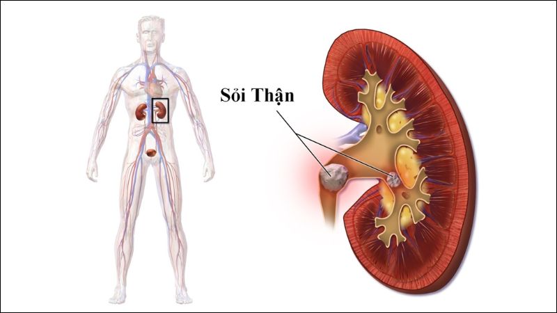 Oxalate có thể kết hợp với canxi trong nước tiểu và tích tụ thành sỏi thận