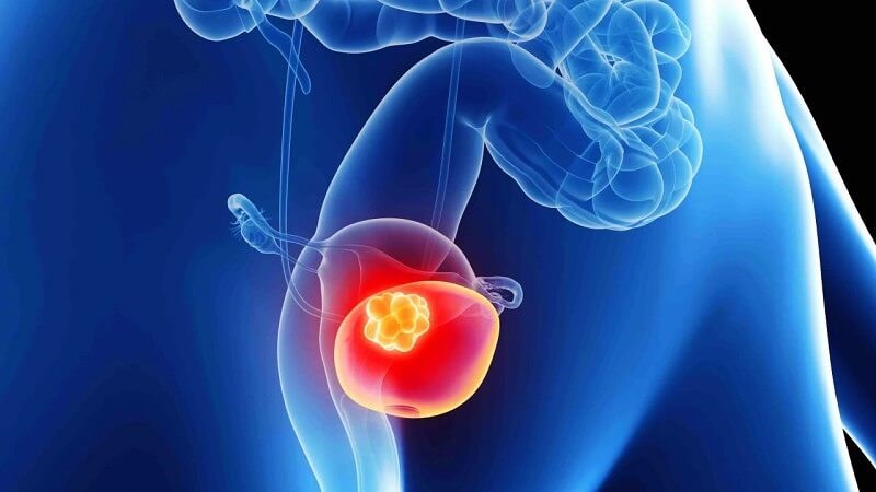 Tiêu thụ quá nhiều sữa đậu nành có thể làm tăng nguy cơ ung thư bàng quang