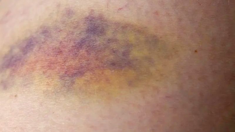 Corticoid còn làm suy yếu cấu trúc mạch máu dưới da, làm tăng nguy cơ xuất huyết và bầm tím