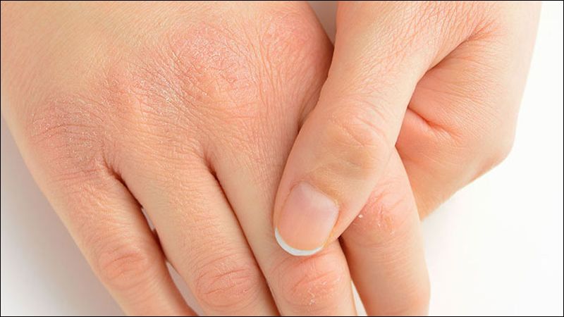 Mức độ teo da phụ thuộc vào độ mạnh của corticoid