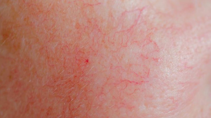 Corticoid có thể gây ra tình trạng giãn mạch máu và rạn da