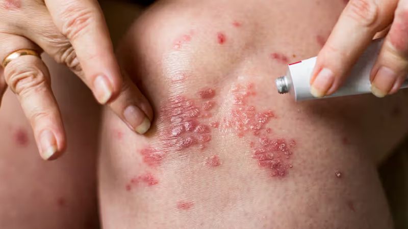Lạm dụng corticoid làm suy yếu phản ứng miễn dịch tự nhiên của da