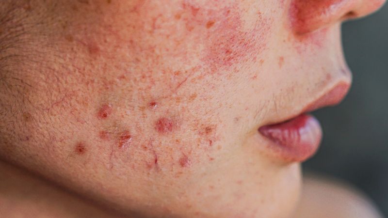 Lạm dụng corticoid có thể làm bùng phát mụn trứng cá khó kiểm soát