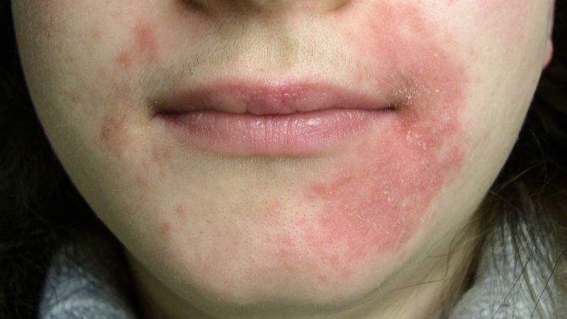 Việc điều trị viêm da dị ứng bằng corticoid kéo dài có thể gây hiện tượng nhờn thuốc