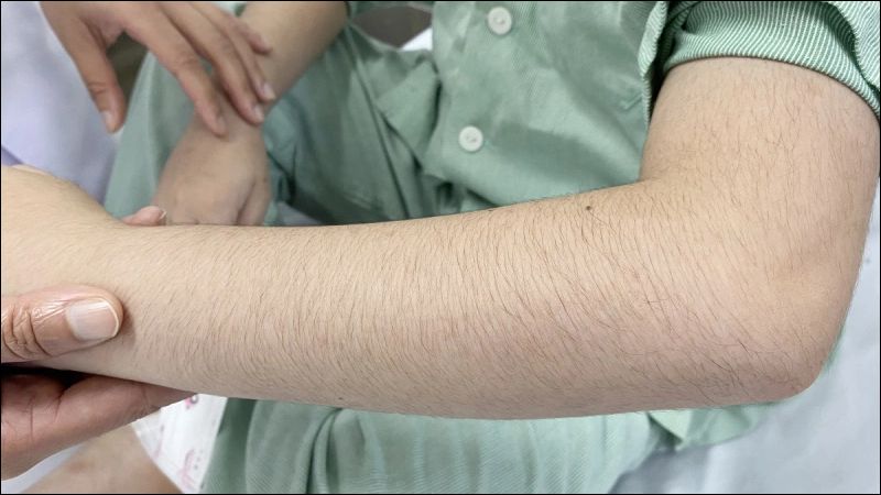 Corticoid có thể gây rậm lông tại vùng da điều trị