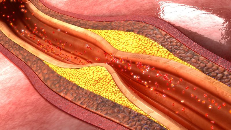Uống trà đen giúp giảm mảng bám cholesterol, hạn chế xơ vữa động mạch