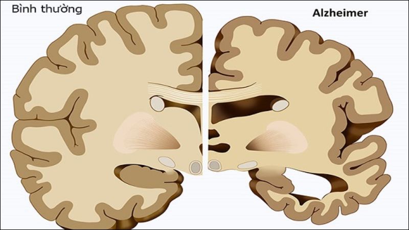 Bệnh Alzheimer sẽ dần phá hủy các tế bào não theo thời gian