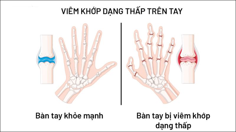 Kefir có thể giúp giảm viêm trong các bệnh tự miễn