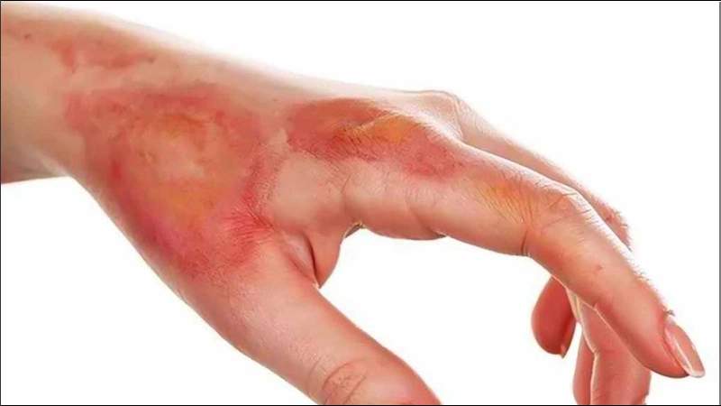 Xông hơi thường an toàn nhưng vẫn có nguy cơ gây bỏng