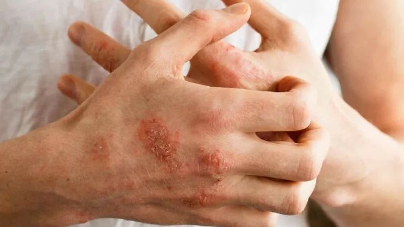 Những người mắc các bệnh tự miễn không nên sử dụng đông trùng hạ thảo
