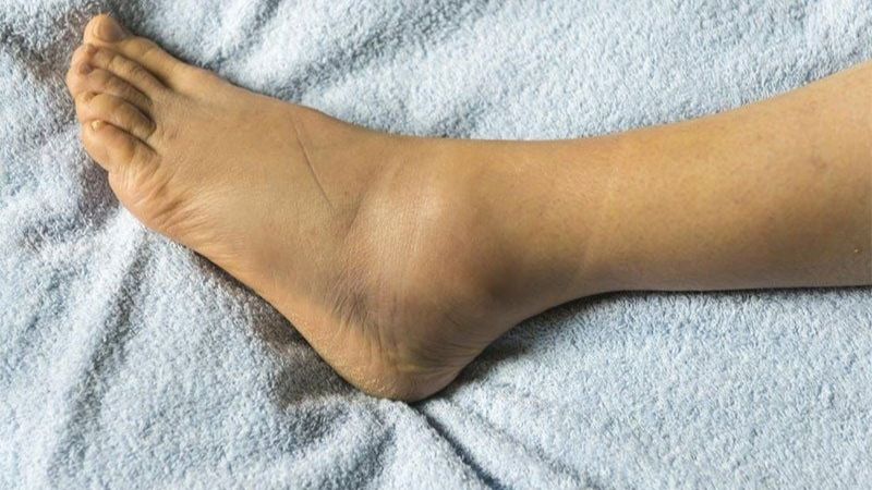 Dịch chiết trâu cổ có hiệu quả kháng viêm giảm phù chân tương đương thuốc indomethacin