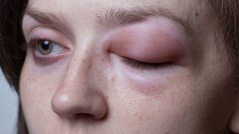 Phù nề là triệu chứng thường gặp sau tiêm filler