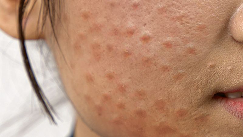 Tiêm filler sai cách có thể gây ra u hạt