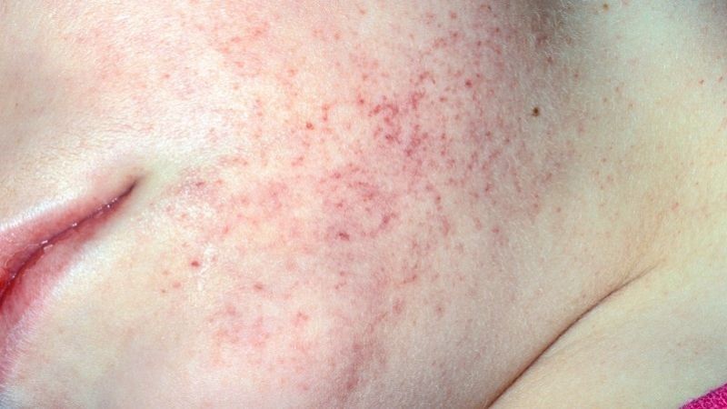 Tình trạng ban đỏ mức độ nhẹ thường xuất hiện tại vị trí tiêm ngay sau khi thực hiện thủ thuật