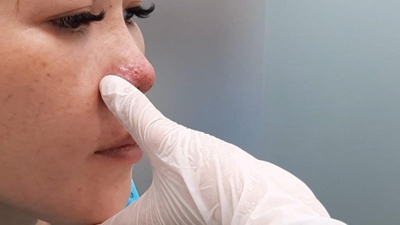 Sau khi tiêm filler, vị trí da có thể xuất hiện viêm và tình trạng tăng sắc tố
