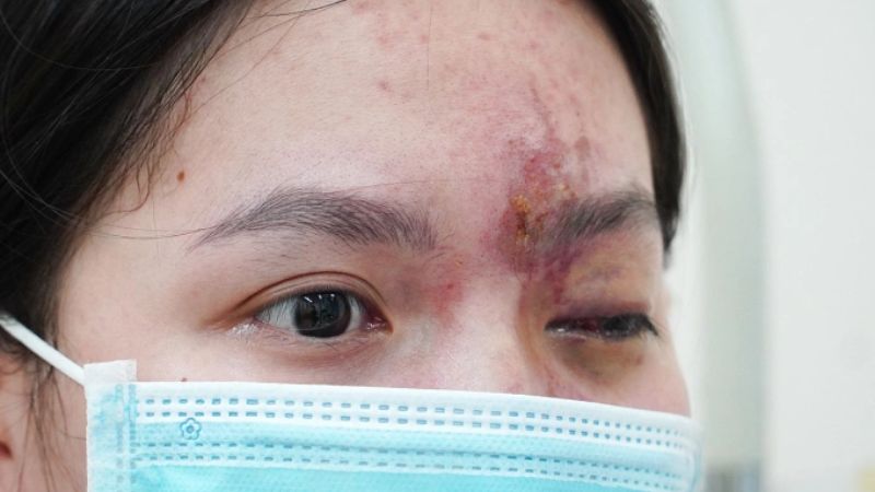 Trong trường hợp tiêm filler ở mặt có thể gây mất thị lực