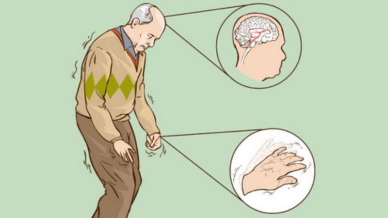 Bệnh Parkinson l&agrave; một dạng rối loạn thần kinh chủ yếu ảnh hưởng đến khả năng vận động