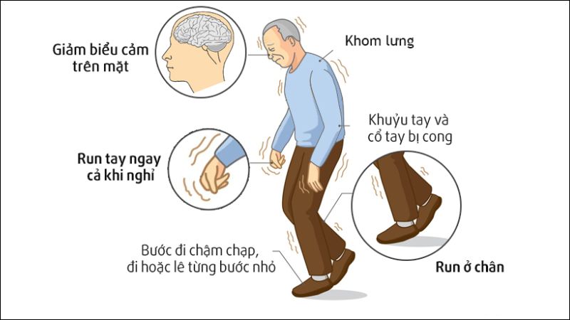 Run rẩy, cứng cơ v&agrave; cử động chậm l&agrave; c&aacute;c triệu chứng thường gặp của bệnh Parkinson