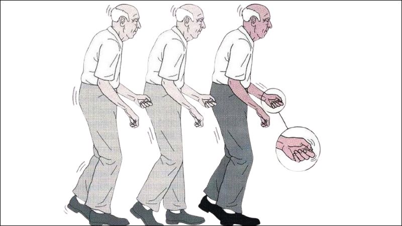Nam giới c&oacute; nguy cơ mắc Parkinson cao hơn nữ giới khoảng 50%
